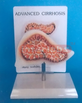 DESK TYPE ADVANCED CIRRHOSIS MODEL WITH DESCRIPTION PLATE